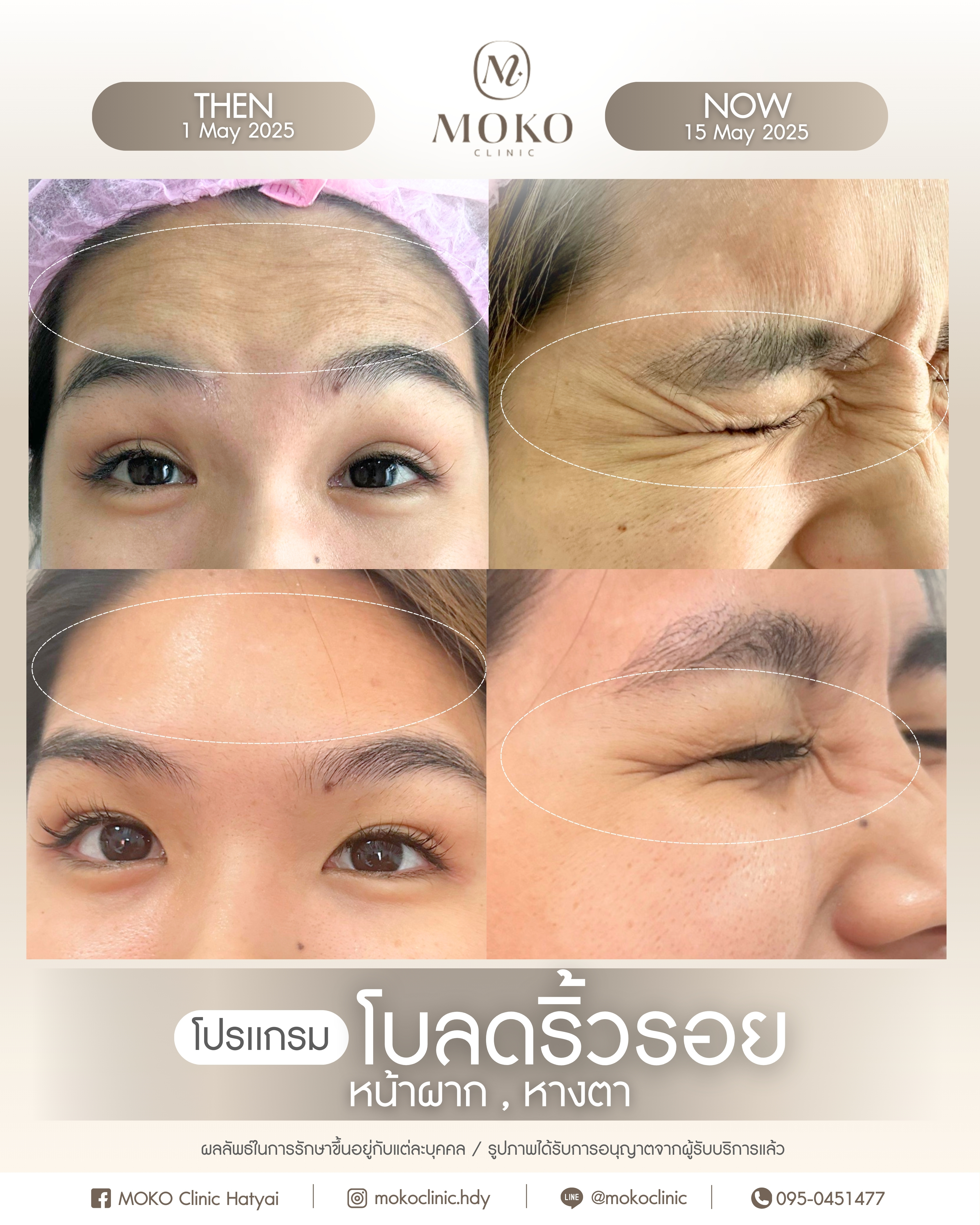 Before After Results 2