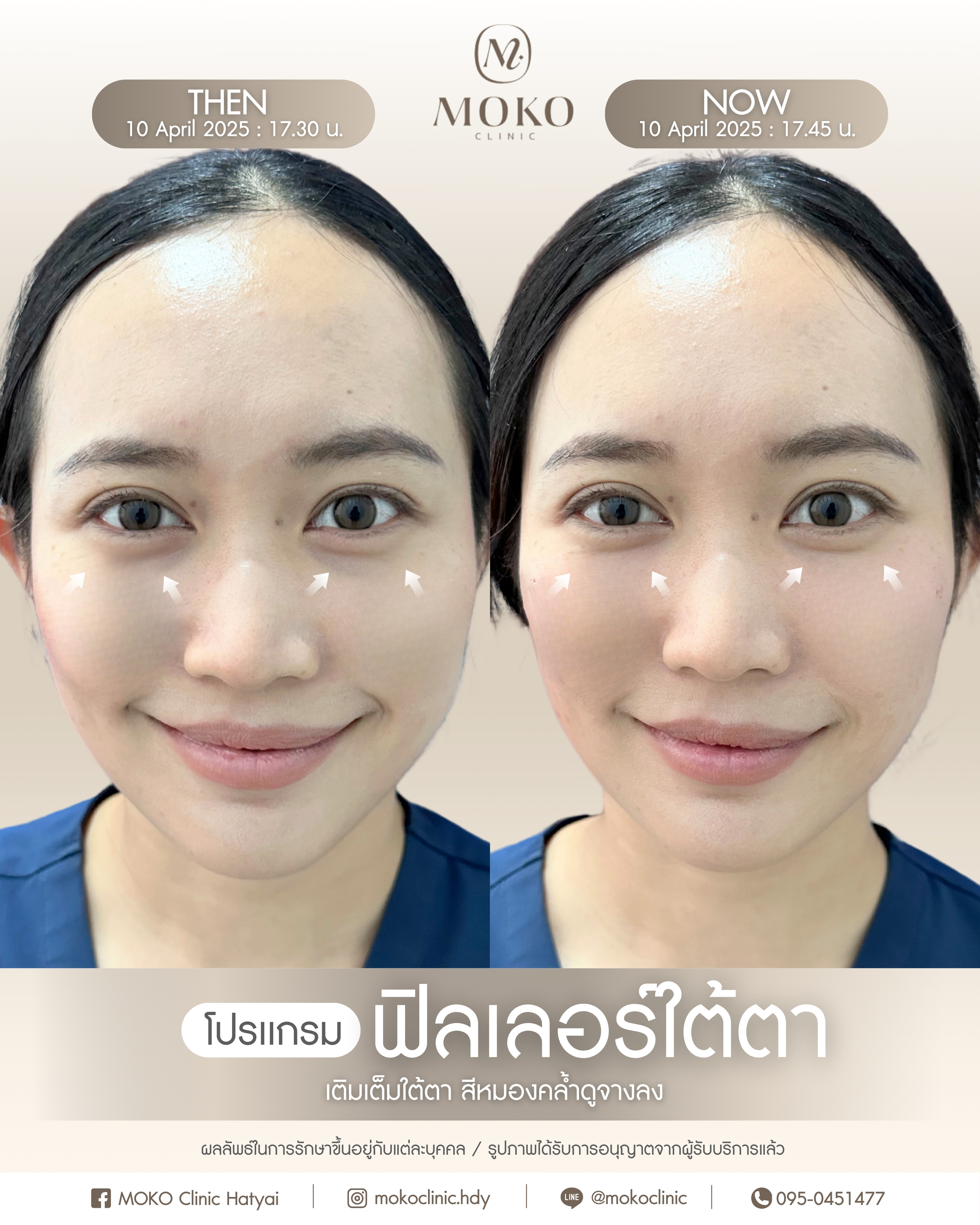 Before After Results 4