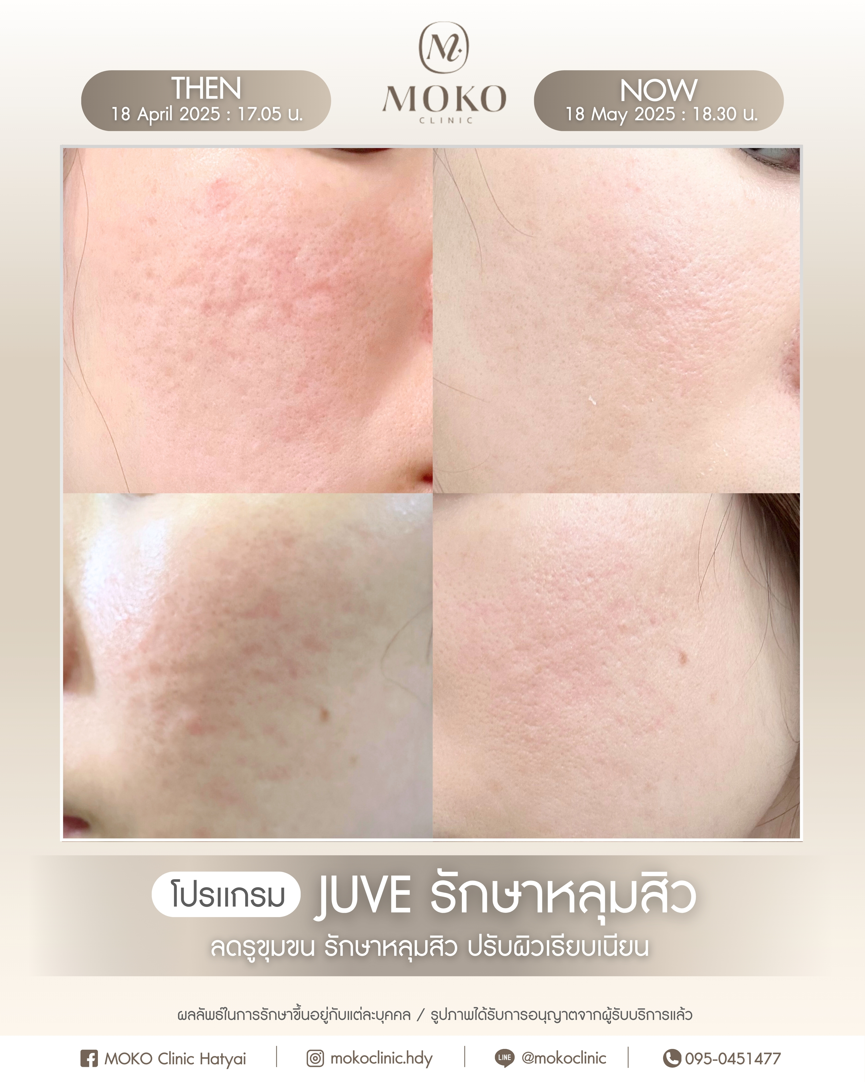 Before After Results 6